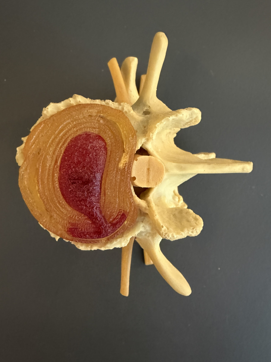 Bandscheibe der Lendenwirbels&auml;ule mit einer Vorw&ouml;lbung und leichter Abnutzung