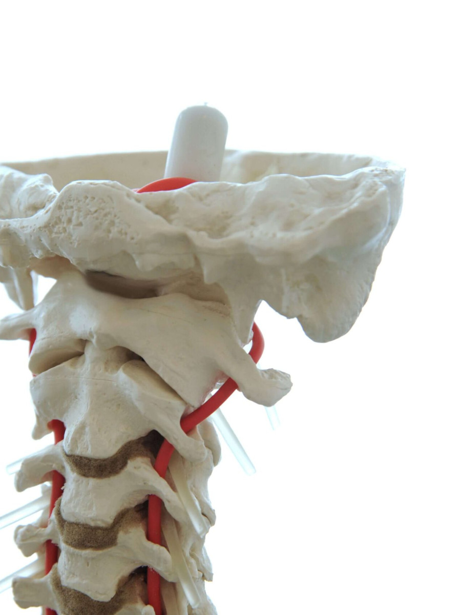Modell der oberen Halswirbels&auml;ule. ganz entscheidend bei zervikogenen Kopfschmerzen