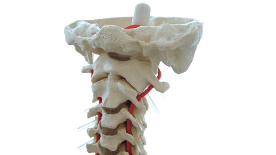 Modell der oberen Halswirbels&auml;ule. ganz entscheidend bei zervikogenen Kopfschmerzen