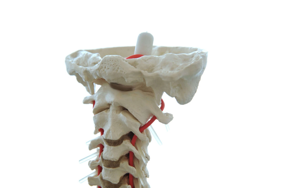 Modell der oberen Halswirbels&auml;ule. ganz entscheidend bei zervikogenen Kopfschmerzen
